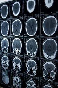 brain injury lawyer in St. Louis, MO